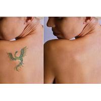 £29 for three sessions of laser tattoo removal on a 2\