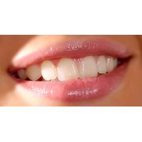 At-Home teeth whitening, with two treatment stages (20min & 20min)