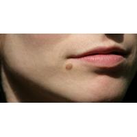 Blood Spots Diathermy Treatment
