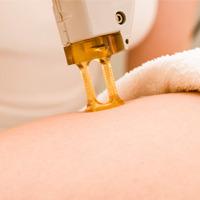 Body Stretch Marks or Scar Removal Treatment -Medium Area (Course of 3)