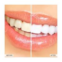 Bright White Teeth Whitener