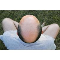 Dracula PRP Therapy for hair loss