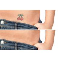 from 14 for one or three 29 tattoo removal sessions on a 3x3 body area ...