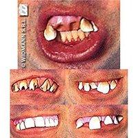 Funny Dentures 6styles Accessory For Fancy Dress