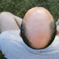 Scalp Hair Simulation: Full Head