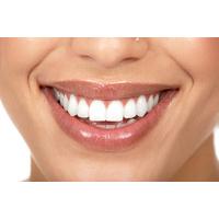 Teeth Cleaning